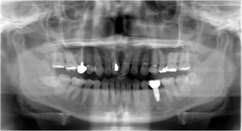 阿久井10　上部構造装着後約4ヶ月後